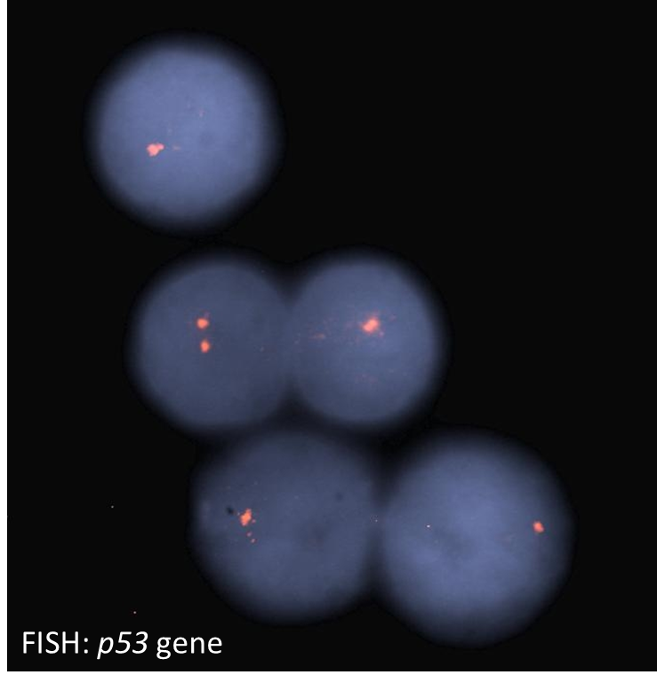 Image 7. FISH for p53 gene confirms deletion of one copy within the majority of cells.